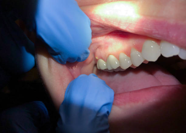 Best Knocked-Out Tooth (Avulsed Tooth) Treatment in Washington Court House, OH